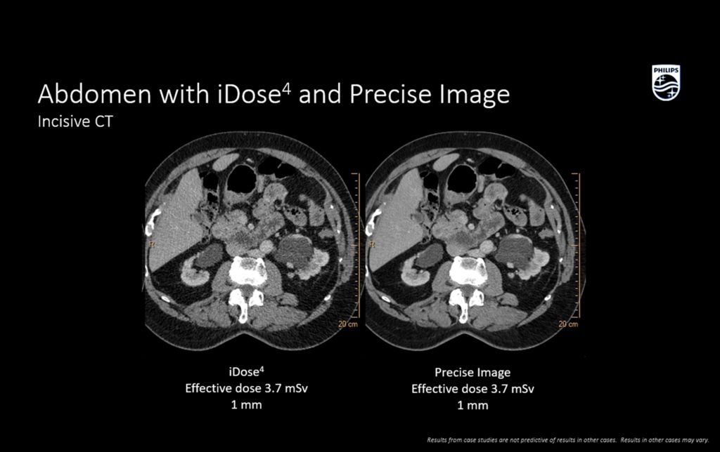 Incisive CT Abdomen with iDose4 and precise image