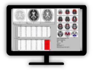 NM NeuroQ Amyloid​ Assessing Amyloid plaque