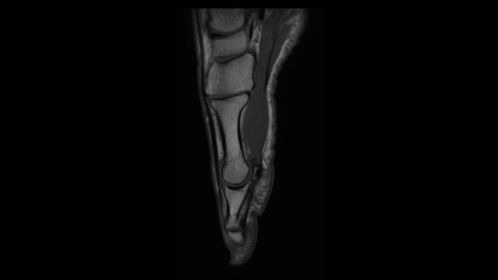 Saggital T1w Forefoot