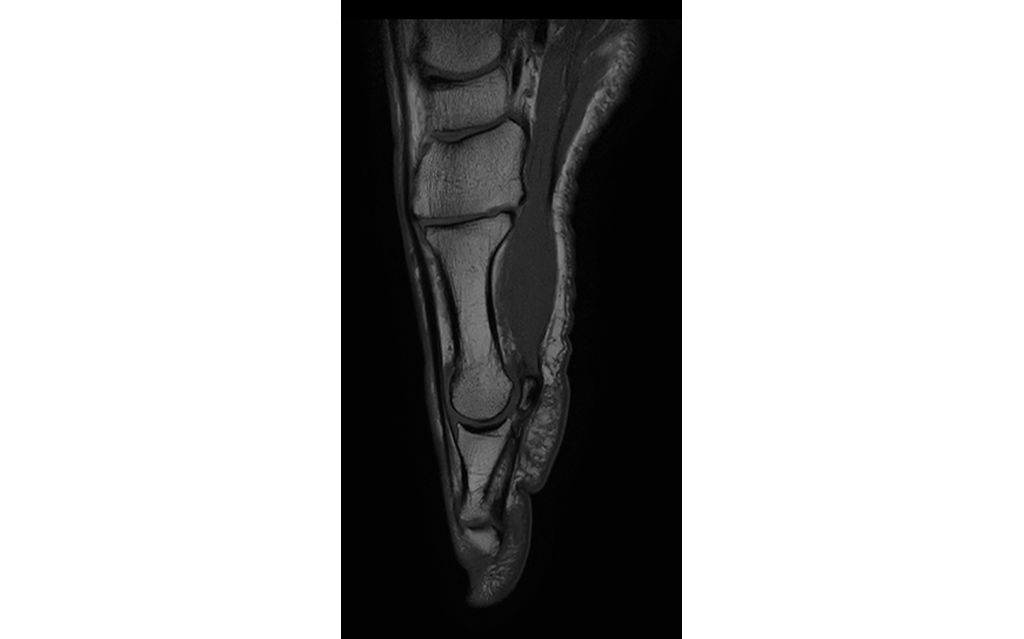 Saggital T1w Forefoot