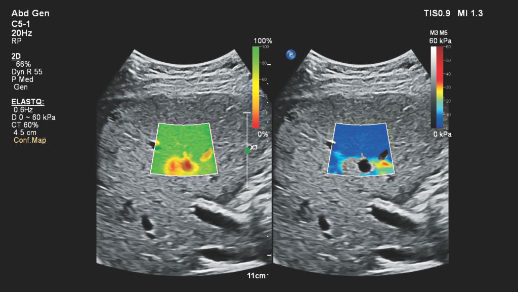 Elastography