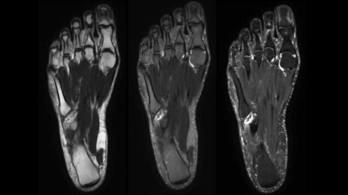 

T2w mDIXON XD TSE with Compressed SENSE

