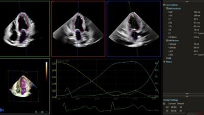 Dynamic HeartModel clinical image showing crisp endocardium quad display 