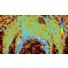 DynaCAD Prostate ADC heat map thumbnail