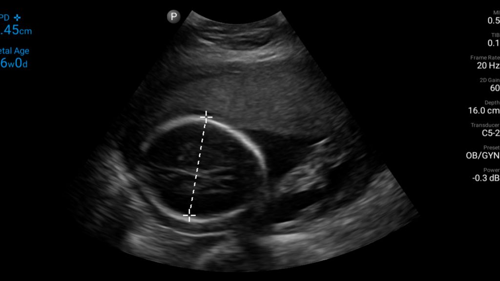 26 week OB biparietal diameter measurement shown using C5-2 transducer.