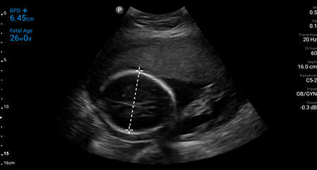 26 week OB biparietal diameter measurement shown using C5-2 transducer.