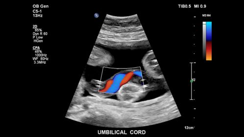 Umbilical cord
