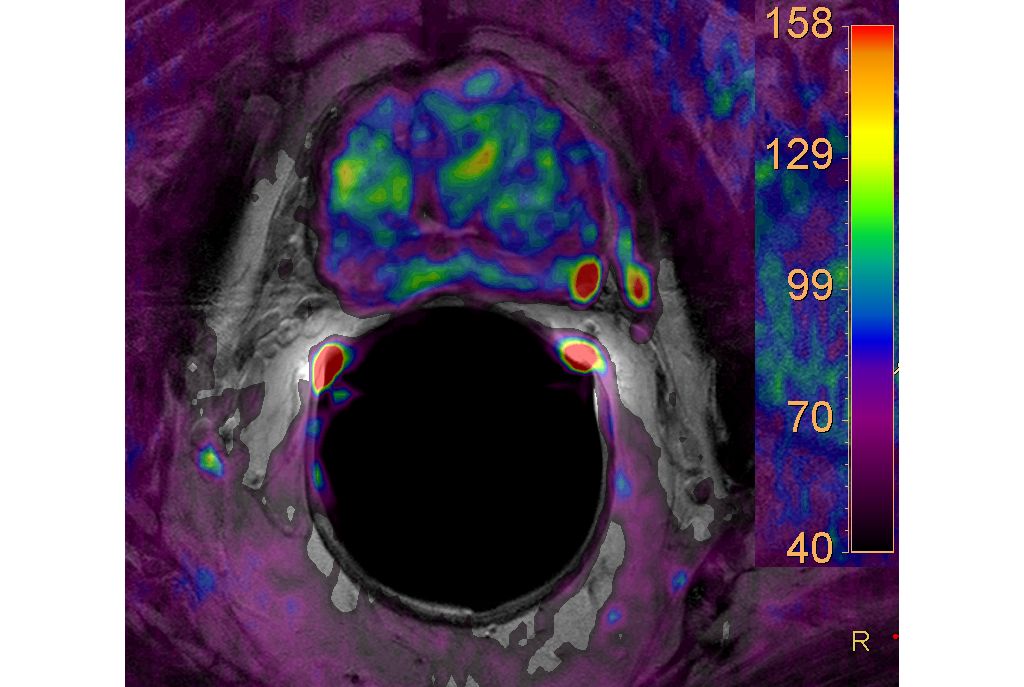 Diffusion (b2500), axial, auf die T2w-TSE-Bilder überlagert