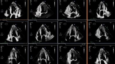 Philips ultrasound screen displaying multiple echocardiogram views for cardiac assessment
