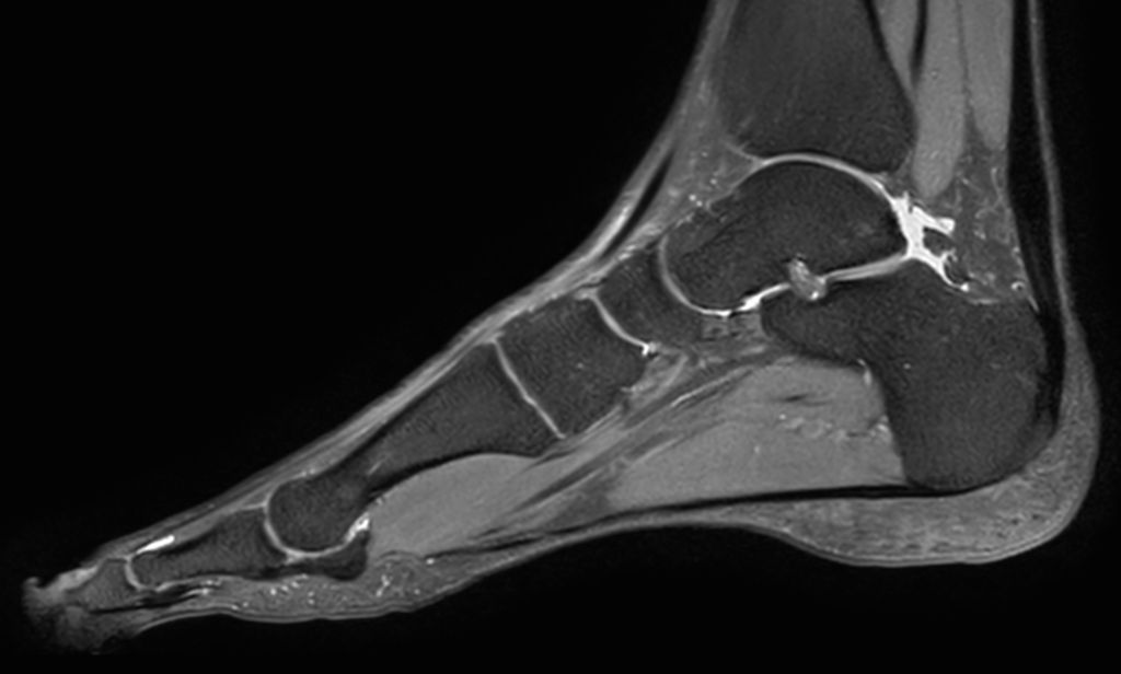 Sagittal 3D VIEW - PDw SPAIR