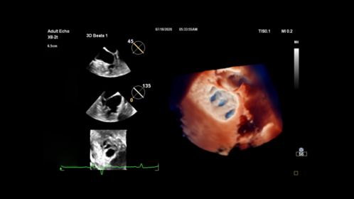 Live 3D TEE TrueVue of Fan shaped LA appendage CV Ultrasound Imaging