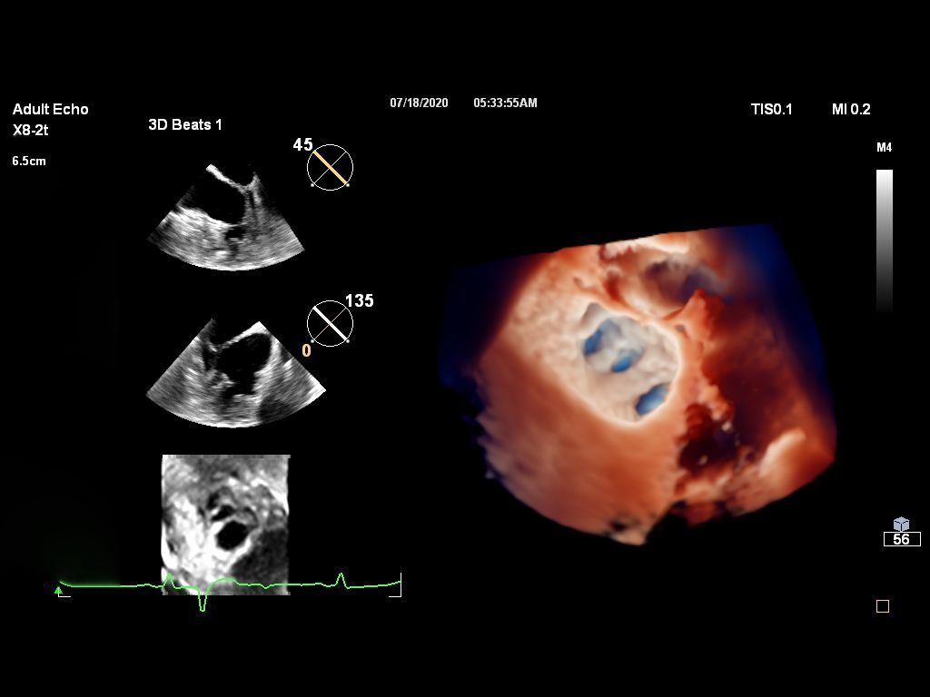 Live 3D TEE TrueVue of Fan shaped LA appendage CV Ultrasound Imaging