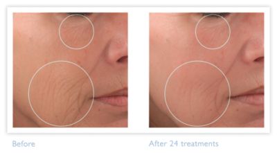 Reduces fine lines — 81%**
