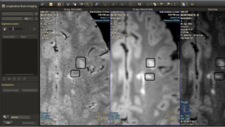 MR Longitudinal Brain Analysis (LoBI)