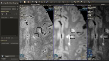 MR Longitudinal Brain Analysis (LOBI)