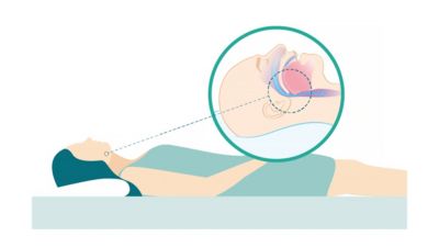 Illustration showing open airway during non supine sleep position
