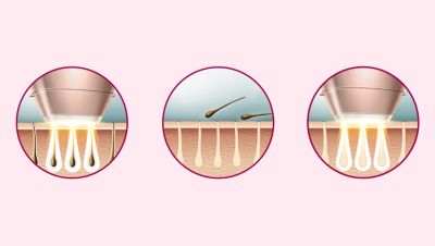 Derivado de IPL profissional, desenvolvido em colaboração com dermatologistas