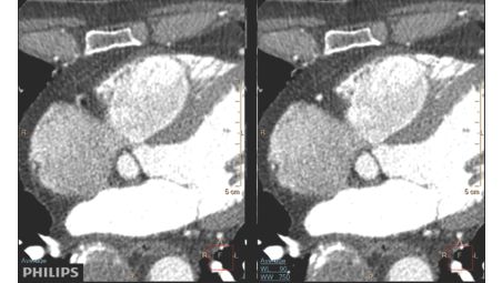 Adquisición de imágenes cardiacas sin movimiento mediante IA