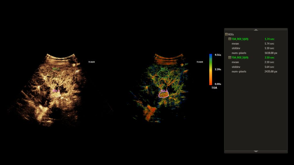 SuperRes MVI Pro Liver SuperRes MVI with TTP and TOA