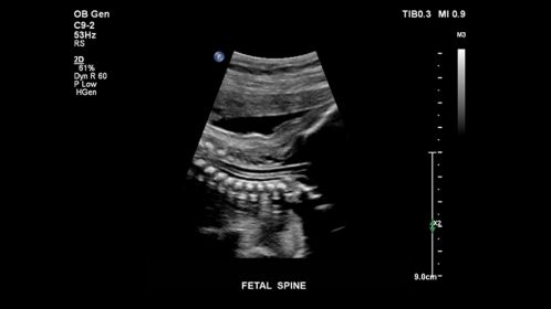 Fetal Spine
