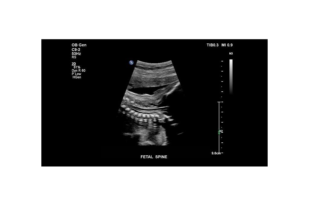 Fetal Spine