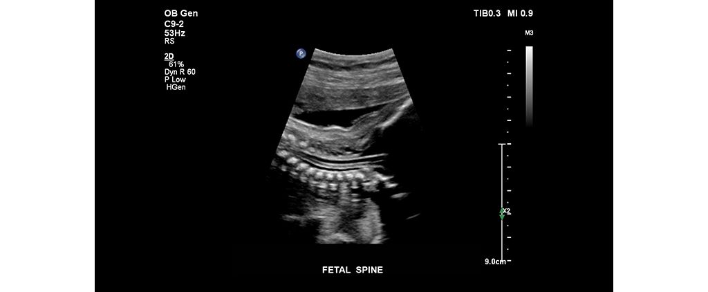 Fetal Spine