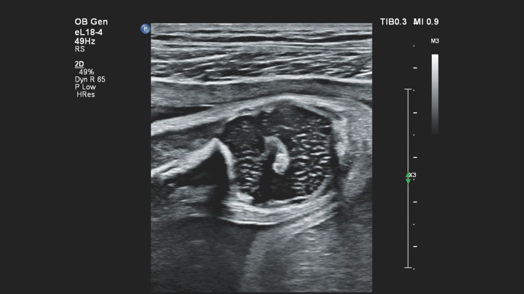 EPIQ Elite the eL18-4 shows the fetal patella