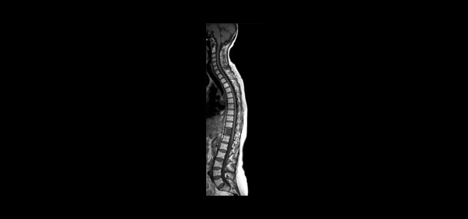Sagittal T1w TSE - Total Spine