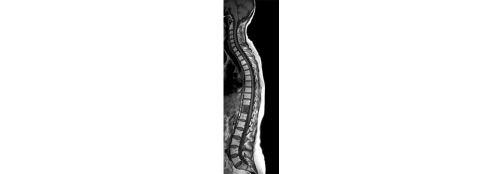 Sagittal T1w TSE - Total Spine