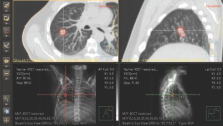 TumorLOC simplifies workflow by sharing a common patient database with Pinnacle