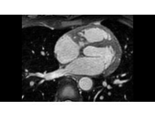 3D Non-selective - Cardiac MR Clinical application