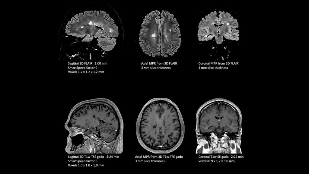 Philips SmartSpeed scans showing white matter lesions in brain