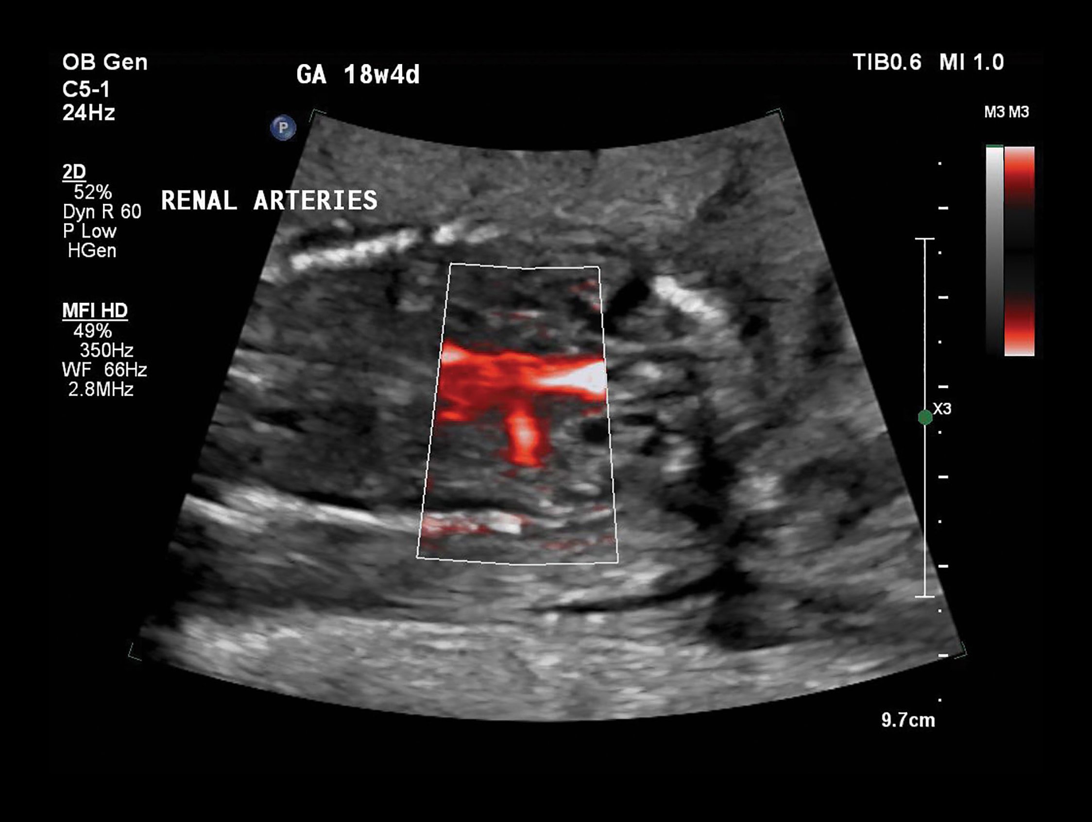 Figure 3 C5-1 transducer sagittal image of the left renal artery using MFI-HD
