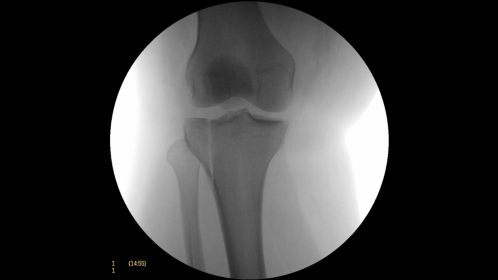 Clinical Image Philips BV Mobile C-arm Pulsera