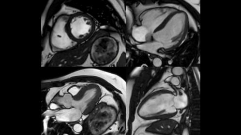 Cine bTFE - Cardiac