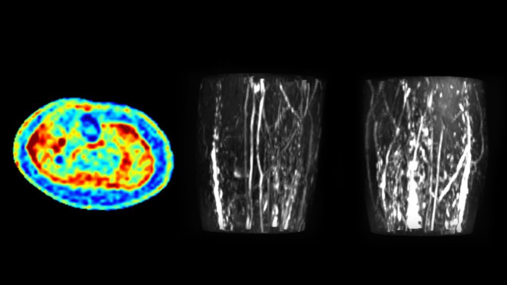  Examples of standardized tissue sodium content map and MRI lymphangiography and maximum intensity projection reconstruction