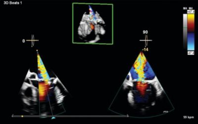 3D echocardiography images showing color Doppler heart valve flow analysis