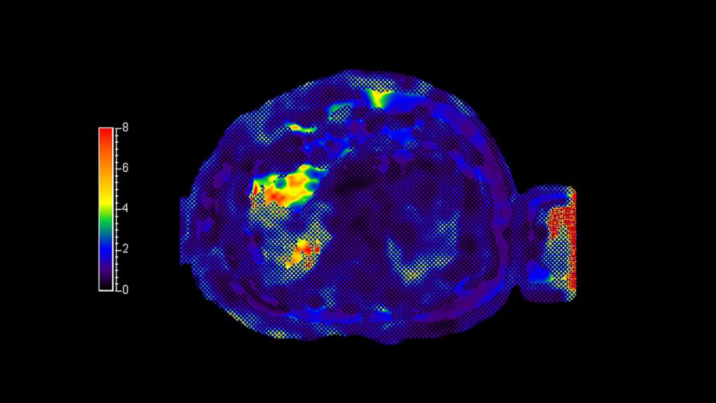 MR Elastography 2D FFE phasecontrast