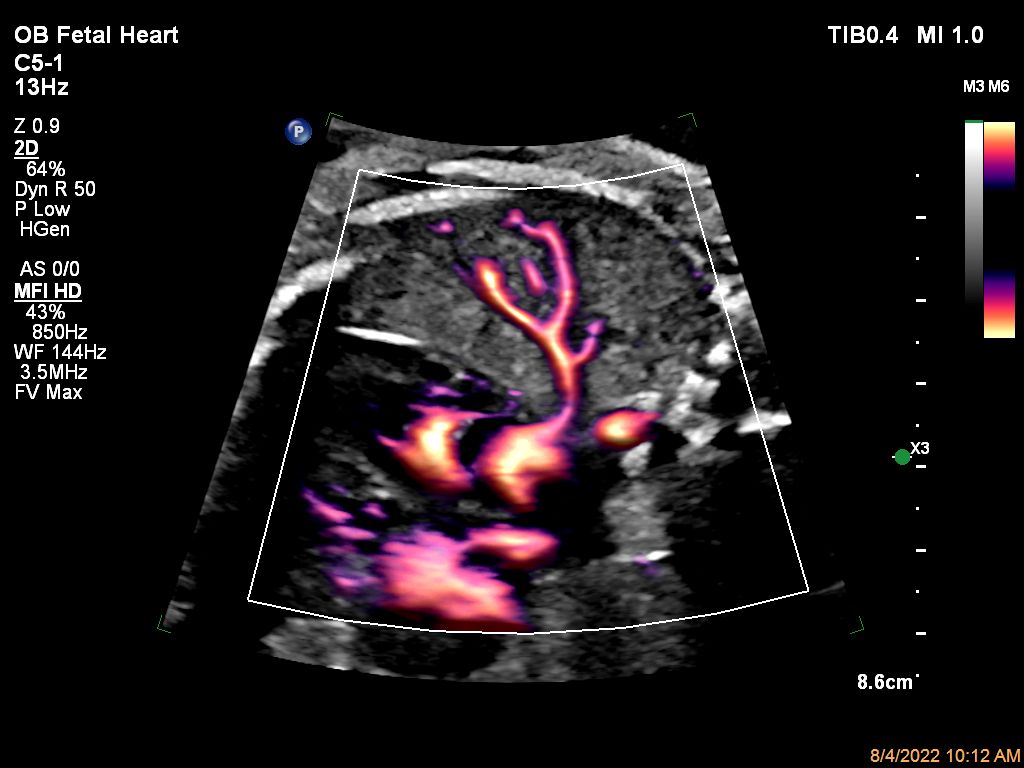 Pulmonary vein and fetal heart MFI with Flow Viewer using C5-1 transducer