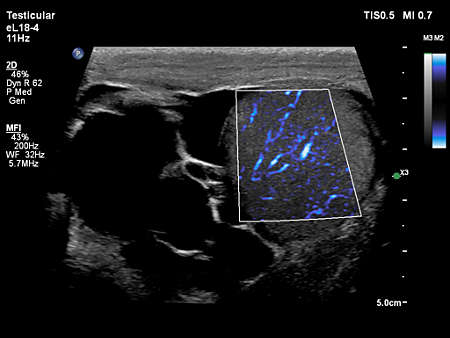 eL18-4 Testicular Imaging with MicroFlow Imaging