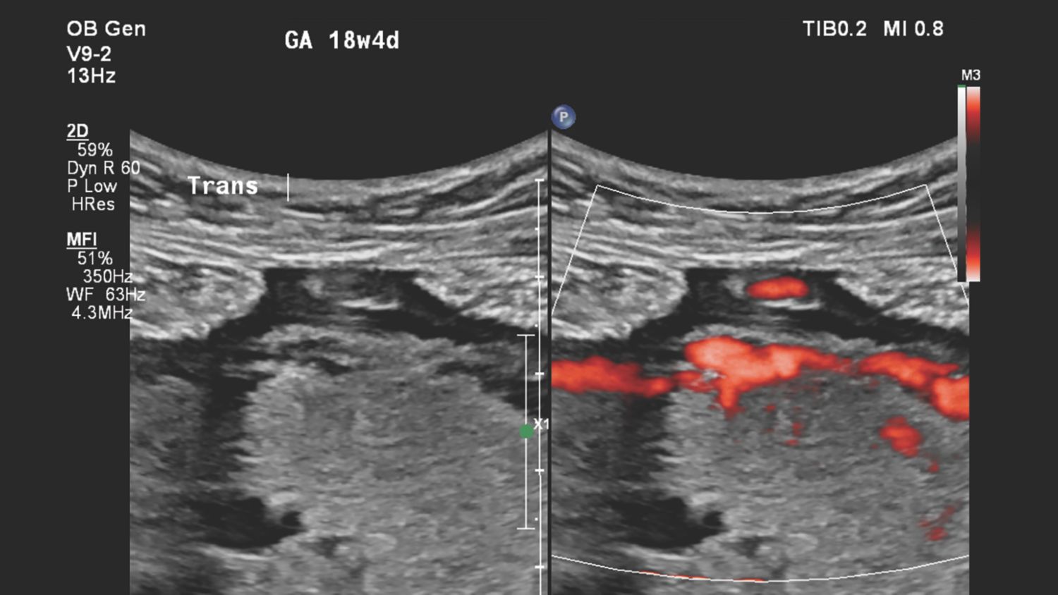 Figure 6 V9-2 transducer 2-D and MFI images of suspected placental abnormality