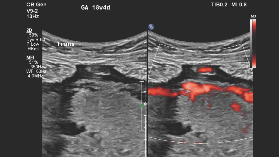 Figure 6 V9-2 transducer 2-D and MFI images of suspected placental abnormality