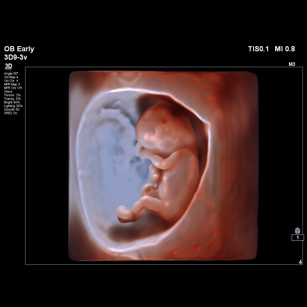 3D ultrasound image using GlassVue of 11-week fetus
