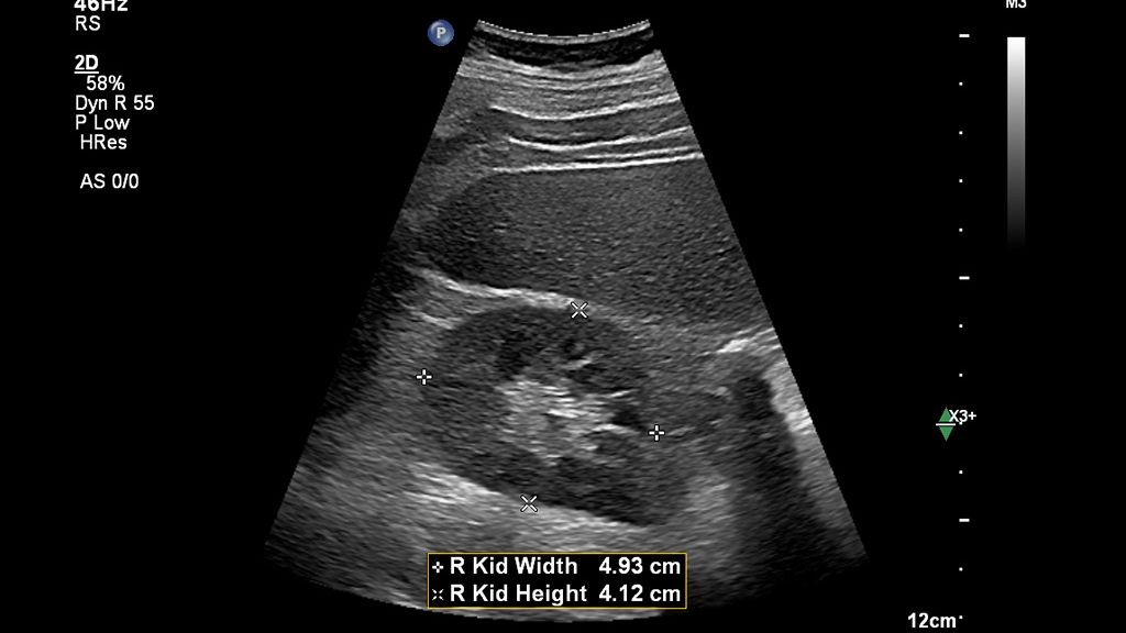 Clinical image using EPIQ Elite and C5-1 transducer showing abdominal right kidney height and width using Auto Measure Abdomen  