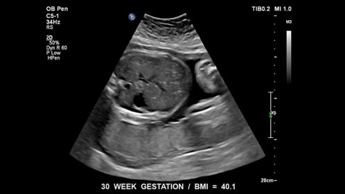 Fetus at 30 week gestation. BMI = 40.1