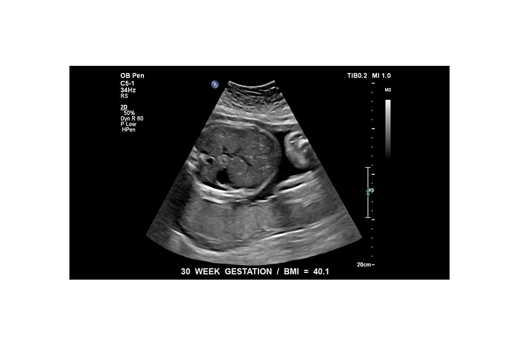 Fetus at 30 week gestation. BMI = 40.1