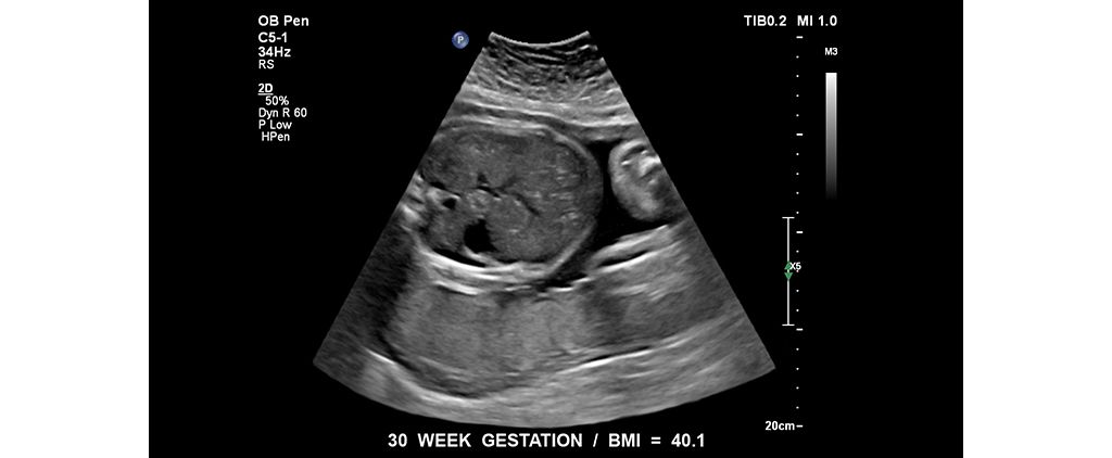 Fetus at 30 week gestation. BMI = 40.1