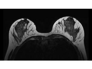 3D BreastVIEW MR clinical application