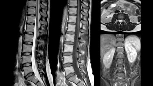 Lumbar Spine