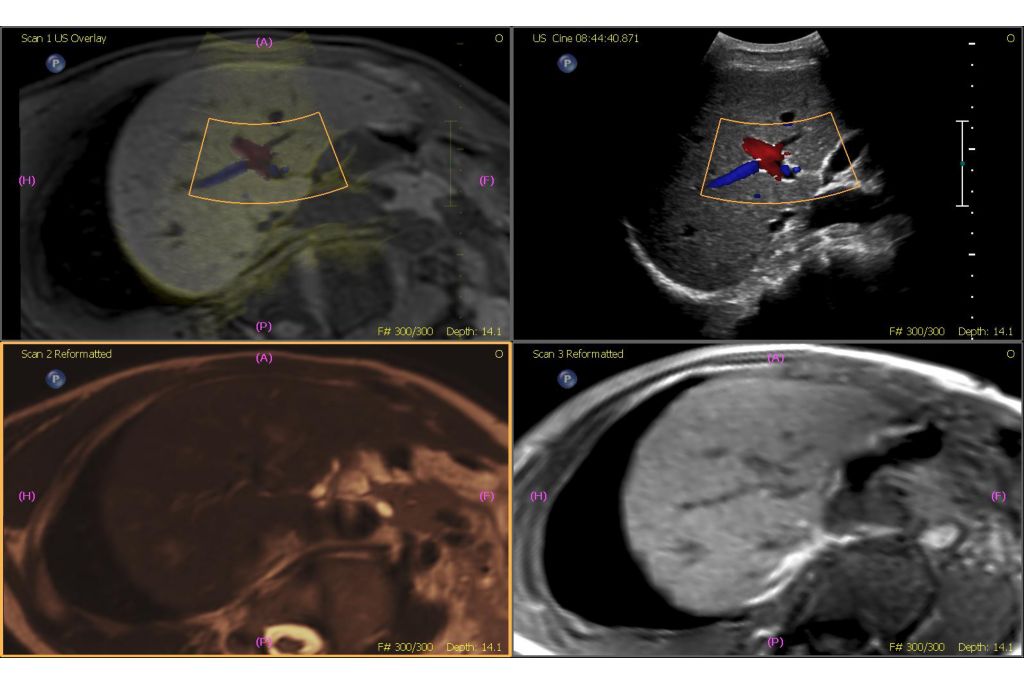 MR and Ultrasound fusion